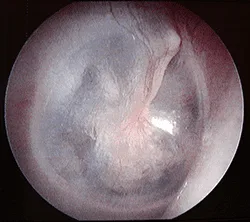 Legacy educational image of a normal eardrum