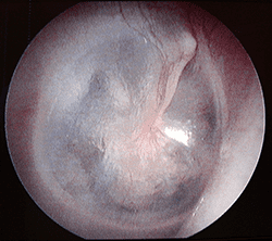 This is an eardrum with the cone of light showing. This is a sign that the eardrum and system are normal. 