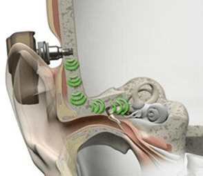 Bone Anchored Implants